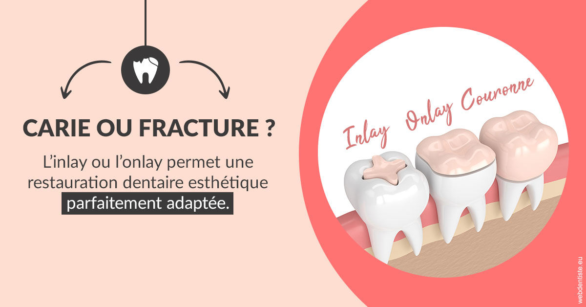 https://dr-leonard-vincent.chirurgiens-dentistes.fr/T2 2023 - Carie ou fracture 2