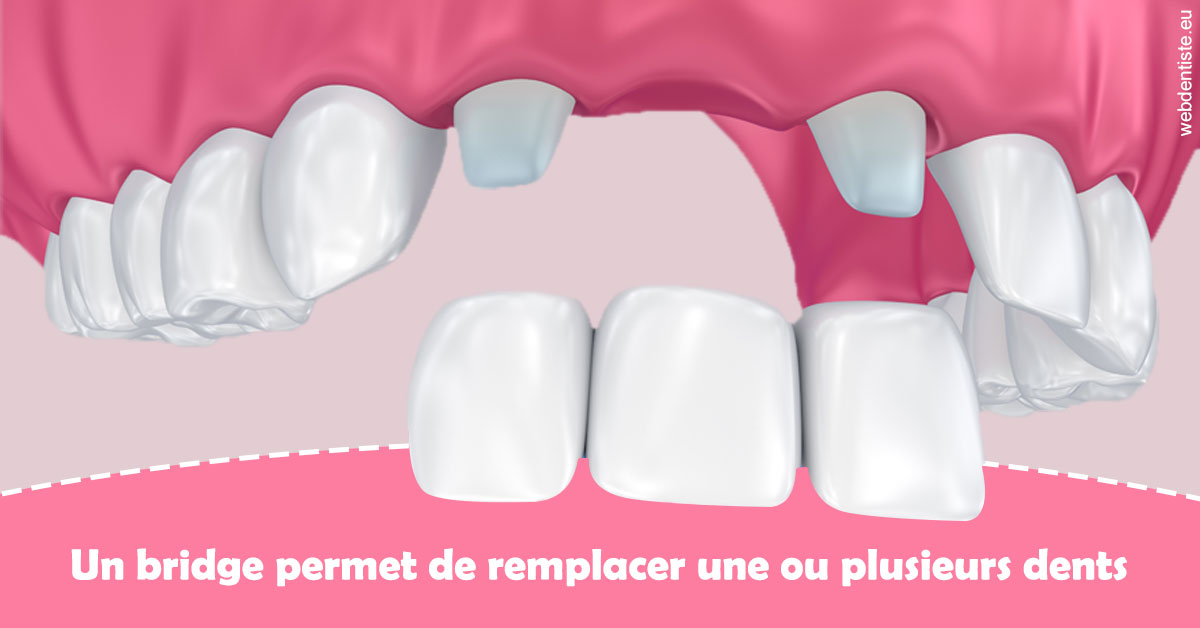 https://dr-leonard-vincent.chirurgiens-dentistes.fr/Bridge remplacer dents 2