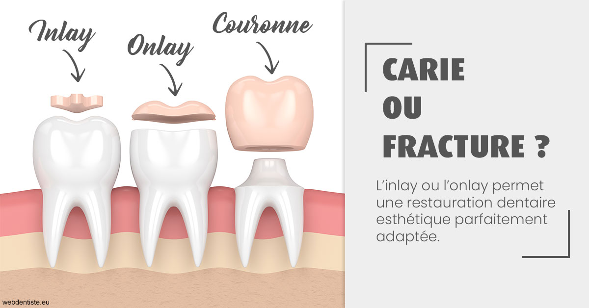 https://dr-leonard-vincent.chirurgiens-dentistes.fr/T2 2023 - Carie ou fracture 1