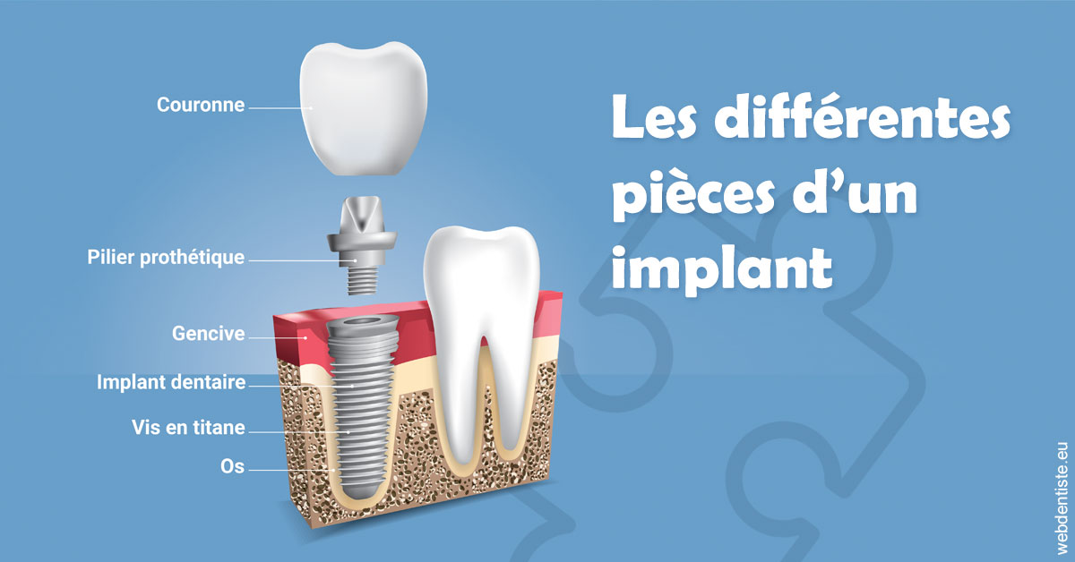 https://dr-leonard-vincent.chirurgiens-dentistes.fr/Les différentes pièces d’un implant 1